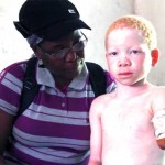 person-with-albinism-2